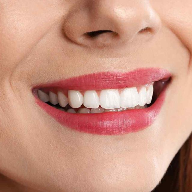 https://kosuyoludis.com/wp-content/uploads/2020/02/teeth-after-2-640x640.jpg